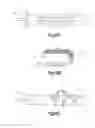 Fig. 15 - Expandable implant