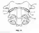Fig. 10 - C1-C2 implant and methods of use