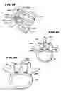 Fig. 07 - Facet arthroplasty devices and methods