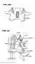 Fig. 09 - Facet arthroplasty devices and methods