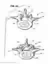 Fig. 13 - Facet arthroplasty devices and methods