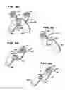 Fig. 17 - Facet arthroplasty devices and methods
