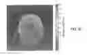 Fig. 11 - SYSTEM AND METHOD FOR ESTIMATING RADIATION DOSE AND DISTRIBUTION USING MEDIUM-DEPENDENT-CORRECTION BASED ALGORITHMS (MDC)