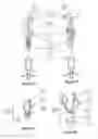 Fig. 06 - Methods and devices for conduit occlusion
