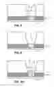 Fig. 09 - Device and method for improving sample injection and stacking