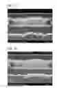 Fig. 08 - Copper electrodeposition in microelectronics
