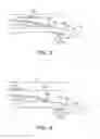 Fig. 03 - Assembly and method for stabilizing a percutaneous cable