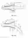 Fig. 05 - Assembly and method for stabilizing a percutaneous cable