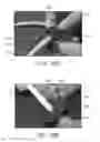 Fig. 11 - Assembly and method for stabilizing a percutaneous cable