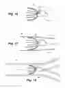 Fig. 06 - Apparatus and method for sensor deployment and fixation