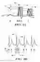 Fig. 04 - Methods and devices that identify overdetection in implantable cardiac systems