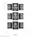 Fig. 03 - Mid-face aesthetic scale and related methods
