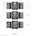 Fig. 05 - Mid-face aesthetic scale and related methods