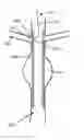 Fig. 01 - Stent graft fenestration