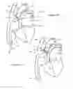 Fig. 08 - Stent graft fenestration