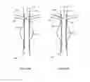 Fig. 09 - Stent graft fenestration