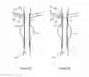 Fig. 10 - Stent graft fenestration