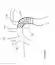 Fig. 11 - Stent graft fenestration