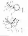 Fig. 12 - Stent graft fenestration