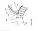 Fig. 13 - Stent graft fenestration