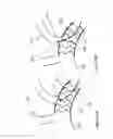 Fig. 14 - Stent graft fenestration