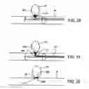 Fig. 12 - Aneurysm flow barrier