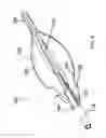 Fig. 05 - Over-the-wire valvulotomes
