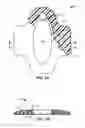 Fig. 02 - Biopsy incision closure device
