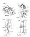 Fig. 04 - Biopsy incision closure device