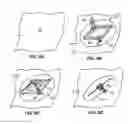Fig. 10 - Biopsy incision closure device