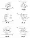 Fig. 05 - IMPLANT AND METHOD FOR FACET IMMOBILIZATION