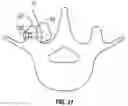 Fig. 12 - IMPLANT AND METHOD FOR FACET IMMOBILIZATION