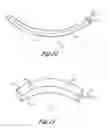 Fig. 07 - Method of implanting and using a subcutaneous defibrillator