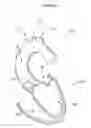 Fig. 02 - Aortic valve stent graft
