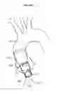 Fig. 04 - Aortic valve stent graft