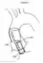 Fig. 05 - Aortic valve stent graft