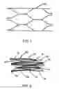 Fig. 02 - INTRALUMINAL STENT GRAFT