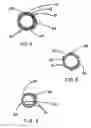 Fig. 04 - INTRALUMINAL STENT GRAFT