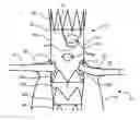 Fig. 01 - Prosthesis having pivoting fenestration