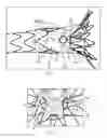 Fig. 05 - Prosthesis having pivoting fenestration