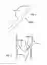 Fig. 02 - INTRALUMINAL SCAFFOLD HAVING AN ENLARGED PORTION