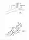 Fig. 04 - INTRALUMINAL SCAFFOLD HAVING AN ENLARGED PORTION