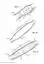 Fig. 05 - INTRALUMINAL SCAFFOLD HAVING AN ENLARGED PORTION