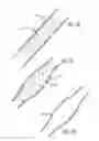 Fig. 10 - INTRALUMINAL SCAFFOLD HAVING AN ENLARGED PORTION