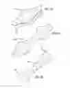 Fig. 18 - INTRALUMINAL SCAFFOLD HAVING AN ENLARGED PORTION