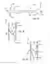 Fig. 22 - INTRALUMINAL SCAFFOLD HAVING AN ENLARGED PORTION