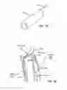 Fig. 27 - INTRALUMINAL SCAFFOLD HAVING AN ENLARGED PORTION