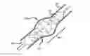 Fig. 01 - METHODS OF TREATING A CONDITION OF A VESSEL IN A PATIENT