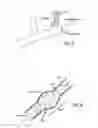 Fig. 04 - METHODS OF TREATING A CONDITION OF A VESSEL IN A PATIENT