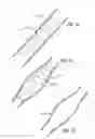 Fig. 10 - METHODS OF TREATING A CONDITION OF A VESSEL IN A PATIENT